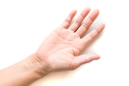 Hand atopic dermatitis symptom skin texture on white background