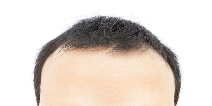 Young man serious hair loss problem for hair loss concept