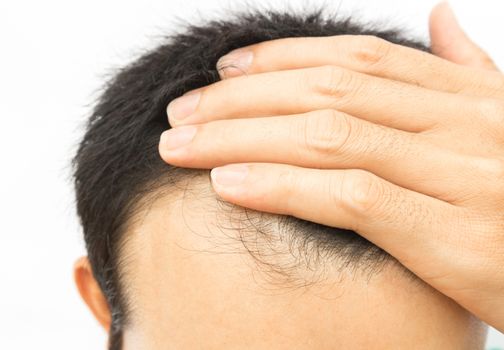 Young man serious hair loss problem for hair loss concept