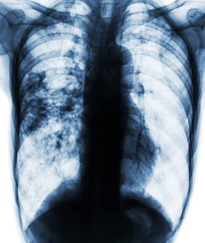 Pulmonary tuberculosis . Film x-ray of chest show patchy infiltrate at right lung due to TB infection .