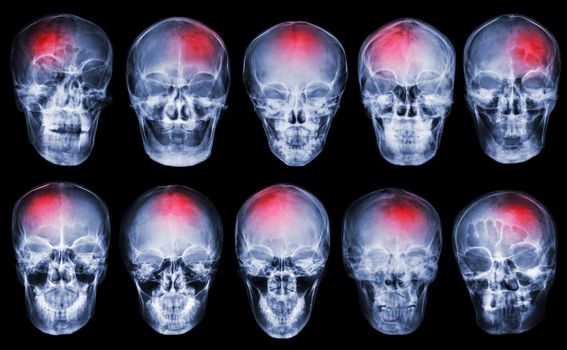 Stroke . Cerebrovascular accident . Set of film x-ray skull .