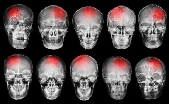 Stroke . Cerebrovascular accident . Set of film x-ray skull .