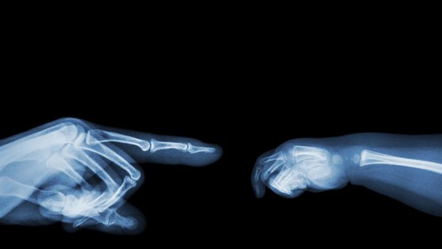 X-ray adult's hand point finger at left side and baby's hand at right side. Blank area at upper side .