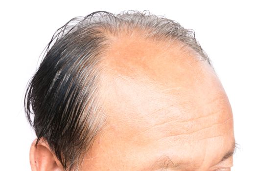 Closeup old man serious hair loss problem and gray for health care shampoo and beauty product concept