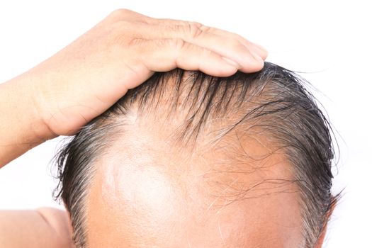 Closeup old man serious hair loss problem and gray for health care shampoo and beauty product concept
