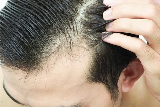 Young man serious hair loss problem for health care shampoo and beauty product concept