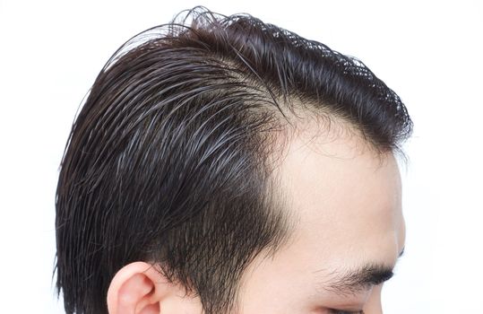 Young man serious hair loss problem for health care shampoo and beauty product concept