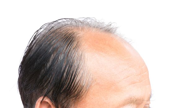 Closeup old man serious hair loss problem and gray for health care shampoo and beauty product concept