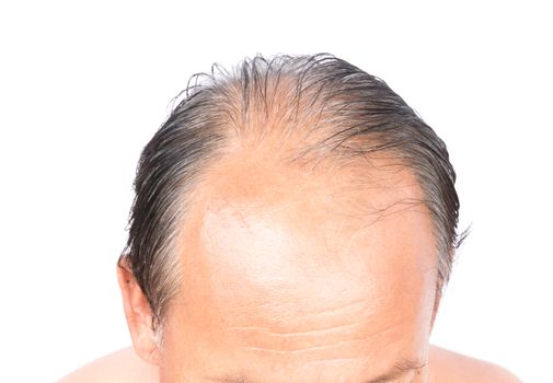 Closeup old man serious hair loss problem and gray for health care shampoo and beauty product concept