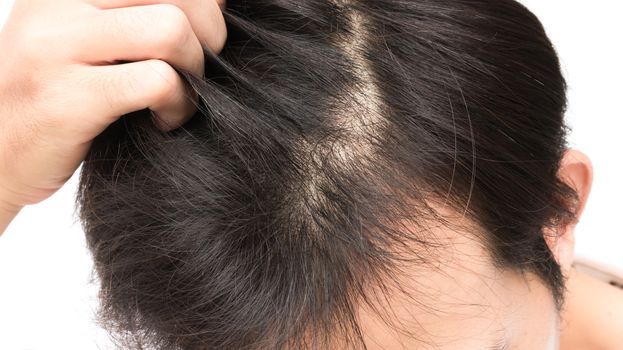 Young man serious hair loss problem for health care shampoo and beauty product concept