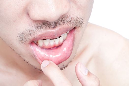 Closeup of lips man problem health care, Herpes simplex