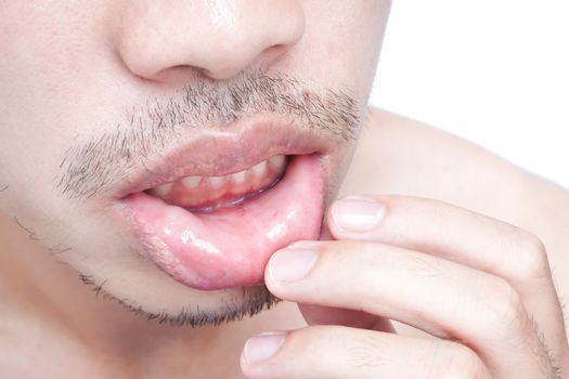 Closeup of lips man problem health care, Herpes simplex