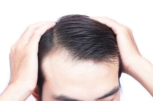 Young man serious hair loss problem for health care medical and shampoo product concept