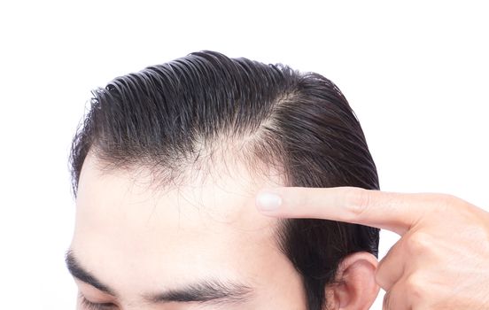 Young man serious hair loss problem for health care medical and shampoo product concept