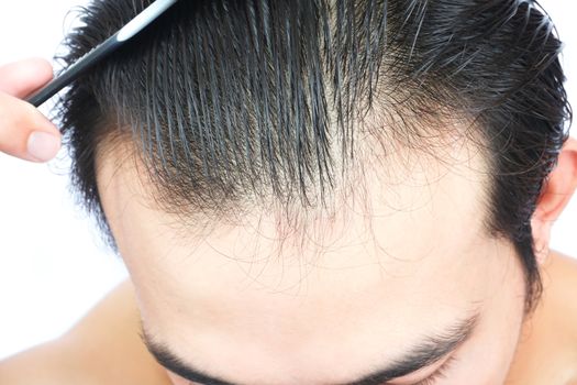 Young man serious hair loss problem for health care medical and shampoo product concept