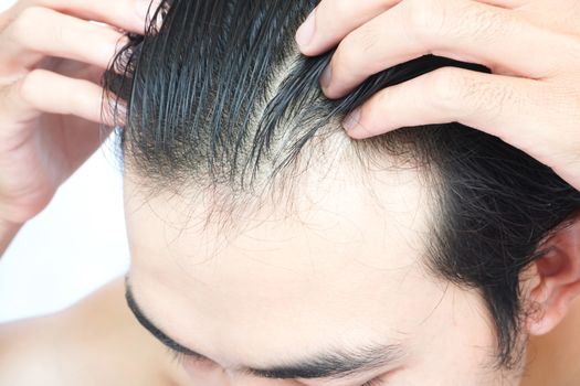 Young man serious hair loss problem for health care medical and shampoo product concept