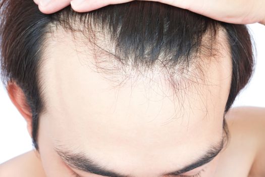 Young man serious hair loss problem for health care medical and shampoo product concept