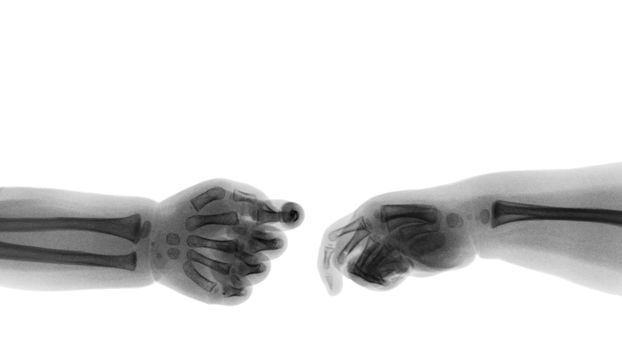 Baby 's hands x-ray and blank area at upper side . ( Shake hands ) . Isolated .