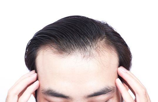 Young man serious hair loss problem for health care medical and shampoo product concept