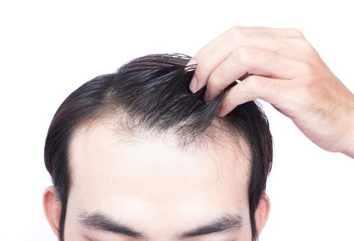 Young man serious hair loss problem for health care medical and shampoo product concept