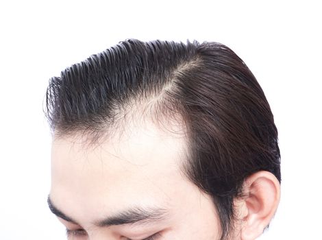 Young man serious hair loss problem for health care medical and shampoo product concept