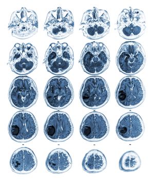 MRI brain show Brain tumor at right parietal lobe .