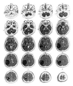 MRI brain show Brain tumor at right parietal lobe .