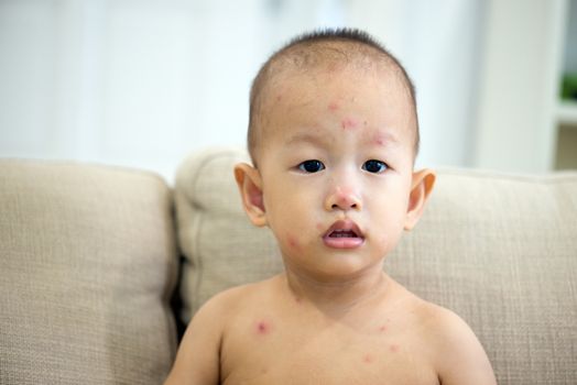 Asian twenty months old baby sitting on couch with red spots of chickenpox, natural photo.
