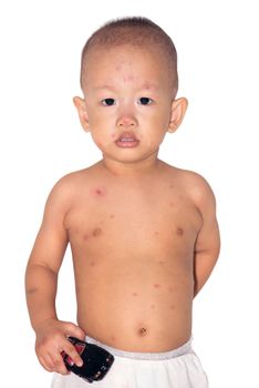 Twenty months old baby boy with chicken pox, standing isolated on white background.