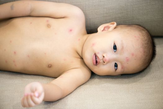 Asian twenty months old baby lying on couch with red spots of chickenpox, natural photo.