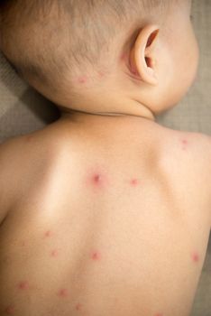 Baby lying on couch with red spots of chickenpox on the back, natural photo.