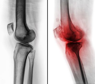 Comparison between normal human knee ( left image ) and osteoarthritis knee ( right image ) . Lateral view .