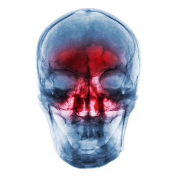 Sinusitis . Film x-ray of human skull with inflamed at sinus .