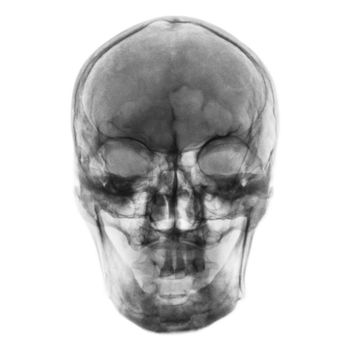 Film x-ray of normal human skull . front view .