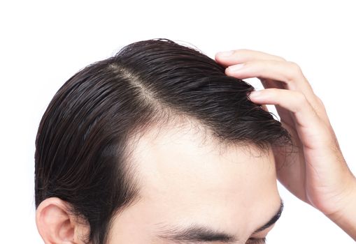 Young man serious hair loss problem for health care medical and shampoo product concept