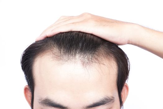 Young man serious hair loss problem for health care medical and shampoo product concept