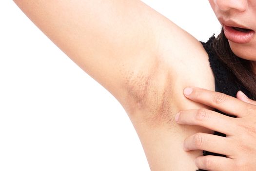 Women problem black armpit on white background for skin care and beauty concept