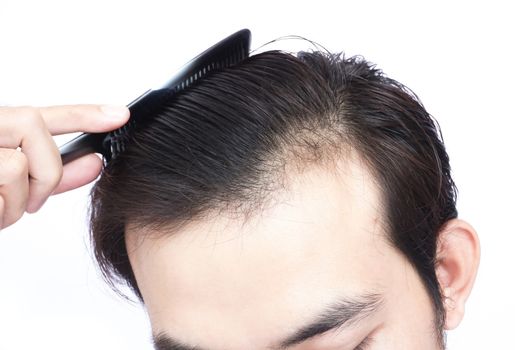 Young man serious hair loss problem for health care medical and shampoo product concept