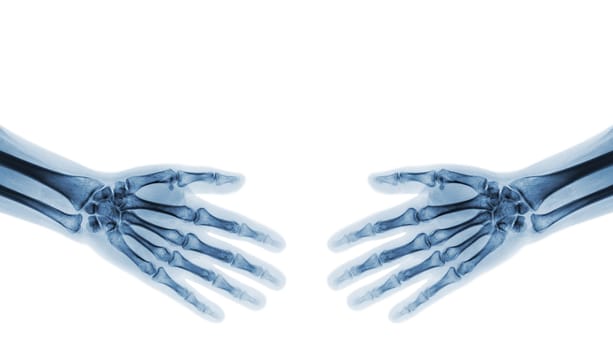 Shake hands . X-ray normal human hands ( blank area at upper side )