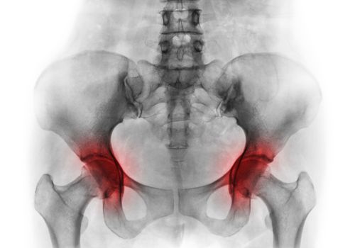 Arthritis both hip . Film x-ray of human pelvis .