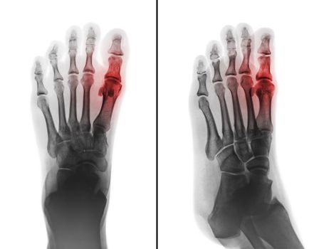 Gouty arthritis . film x-ray of human foot and arthritis at first metatarsophalangeal Joint . 2 position ( front and side view )