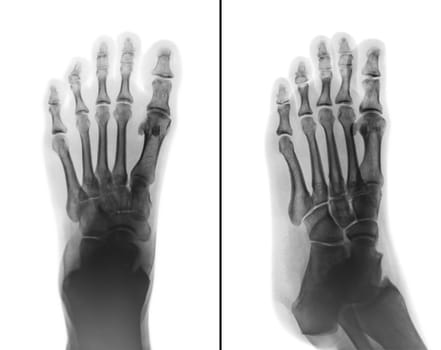 Film x-ray both normal human foots . 2 position ( front view and side view )