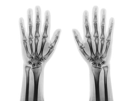 Film x-ray of both normal human hands . front view .