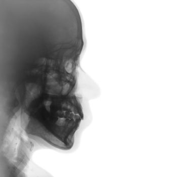 Film x-ray of normal human skull . lateral view . blank area at right side .
