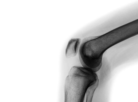 Film x-ray of normal knee joint and blank area at left side .