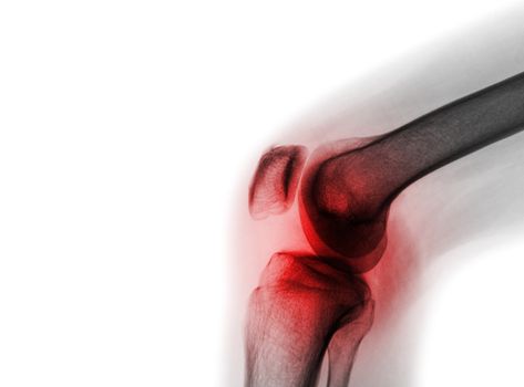 Film x-ray knee joint with arthritis ( Gout , Rheumatoid arthritis , Septic arthritis , Osteoarthritis knee ) and blank area at left side