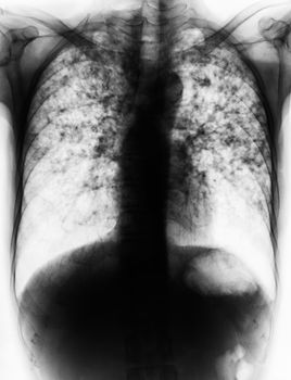 Pulmonary Tuberculosis . Film chest x-ray show fibrosis , interstitial infiltration both lung due to Mycobacterium tuberculosis infection .