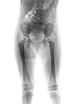 Film x-ray normal body of child ( Lower half of body )