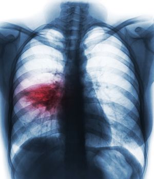 Pneumonia ( film chest x-ray show alveolar infiltrate at right middle lung ) ( image for pulmonary tuberculosis . Mers-CoV . SARS )