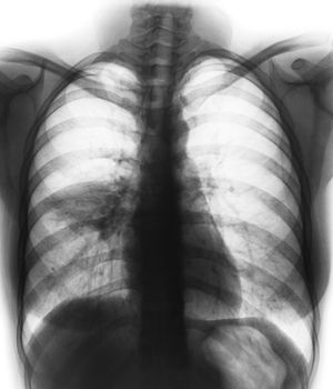 Pneumonia ( film chest x-ray show alveolar infiltrate at right middle lung ) ( image for pulmonary tuberculosis . Mers-CoV . SARS )